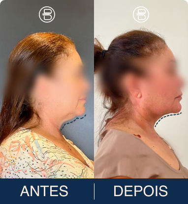 Transformação Caso Clínico 1 - Antes e Depois Lipo de Papada Dr. Bruno Noronha